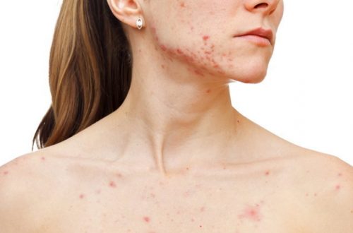 Acne - Trattamento per l'acne