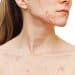 Acne - Trattamento per l'acne