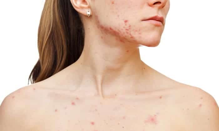 Acne - Trattamento per l'acne